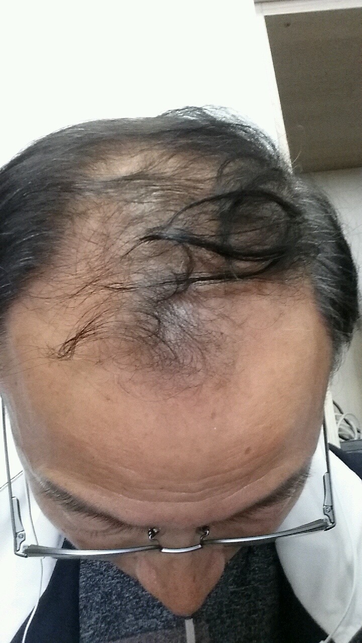 20년 탈모로 괴로웠던 세월을  이제 추억으로 .... 